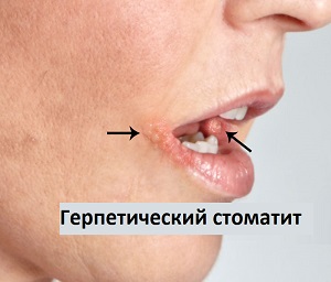 Народные средства лечения эндокринной офтальмопатии