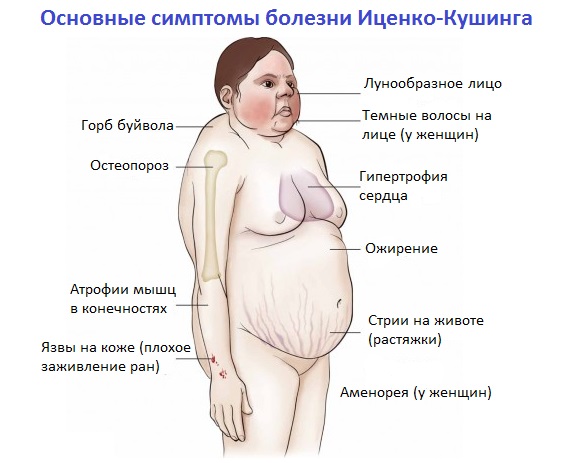 Симптомы болезни Иценко-Кушинга