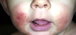 Сыпь вокруг рта при алергии