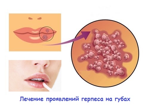 Проявления герпеса на губах