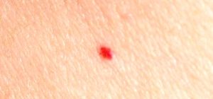 Красная точка на теле