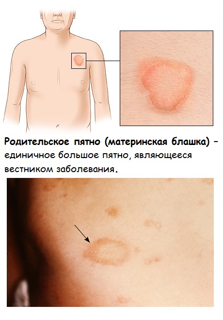 Розовый лишай у человека: симптомы, лечение, фото