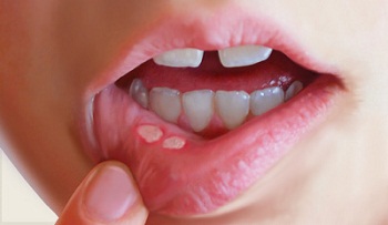 Афтозный стоматит у ребенка на губе
