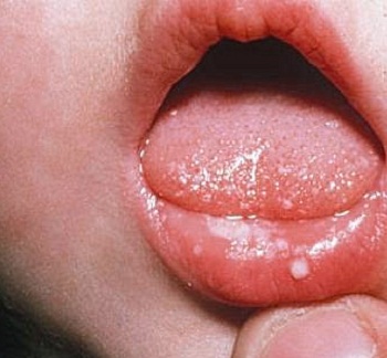 Кандидозный стоматит у ребенка на слизистой губы