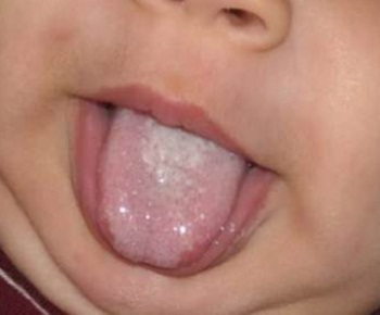 Кандидозный стоматит у ребенка на языке