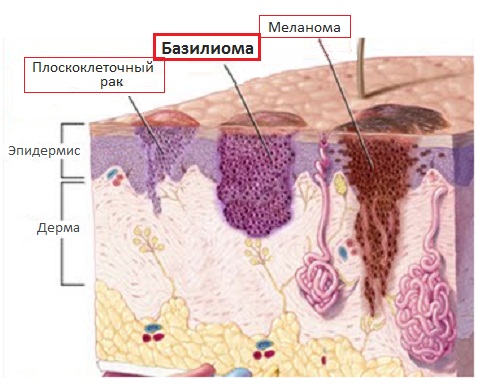 Сравнение базалиомы с меланомой и плоскоклеточным раком