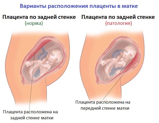 Низко расположенная плацента! | форум для беременных