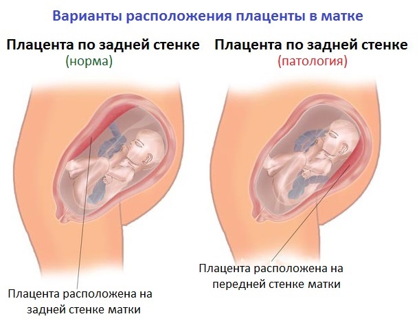 Плацента по передней стенки матки