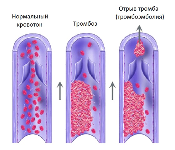 Тромб фото в пробирке