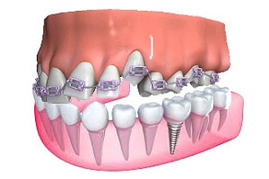 Ортопедические процедуры в стоматологии