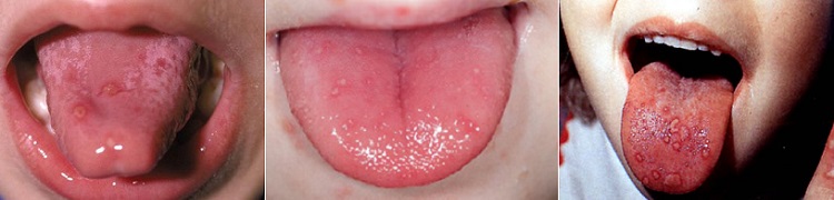 Красные пятна на языке у ребенка при энтеровирусном везикулярном стоматите 