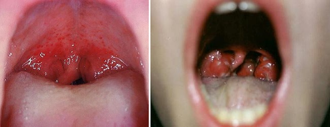 Воспаление горла при скарлатине у ребенка