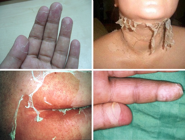 Шелушение кожи у ребенка после скарлатины