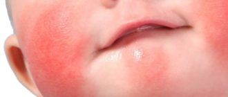Красные пятная на щеках грудничка при диатезе