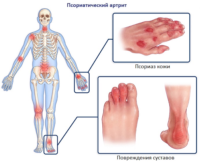 Псориаз - причины симптомы фото виды и лечение псориаза