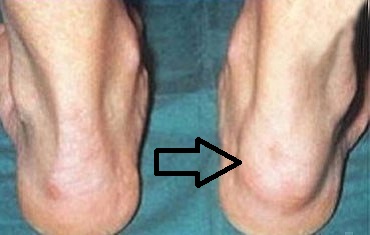 Псориатический артрит на ноге