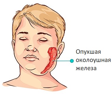 Паротит у взрослых: симптомы, фото и лечение